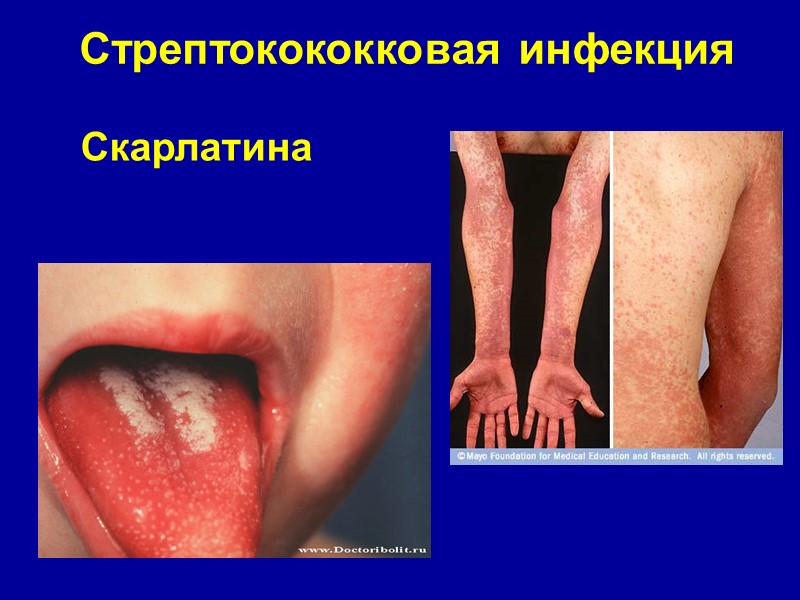 Стрептокококковая инфекция Скарлатина